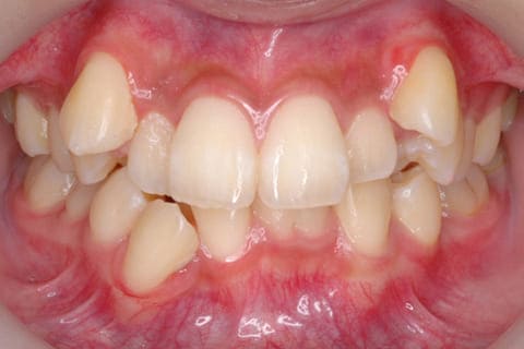 八重歯の歯列矯正歯科の治療前