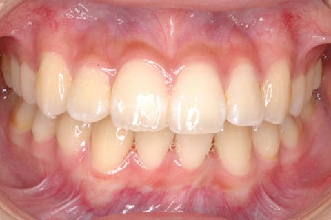 八重歯の歯列矯正歯科の治療後