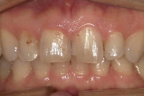 歯を削らないラミネートべニア審美歯科の治療前