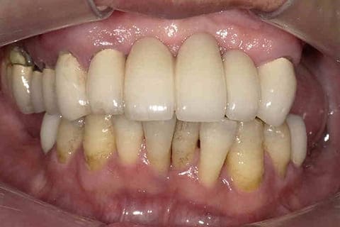 オールオン4インプラントの治療前