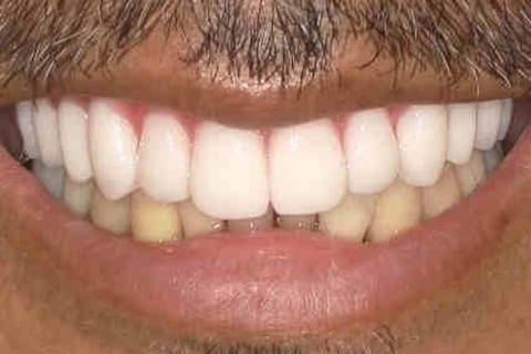 オールオン4インプラントの治療後