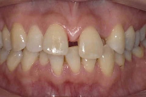 非抜歯マウスピース矯正の治療前