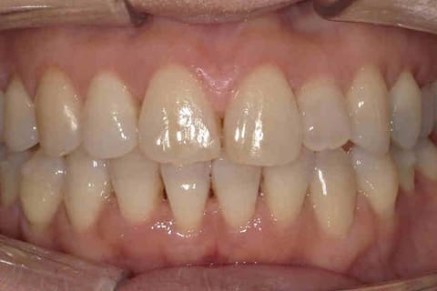 非抜歯マウスピース矯正の治療後