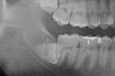 水平の親知らずの抜歯の治療前