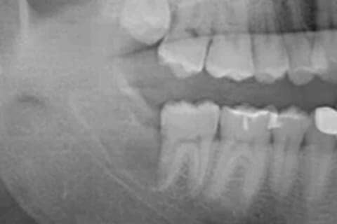 水平の親知らずの抜歯の治療後