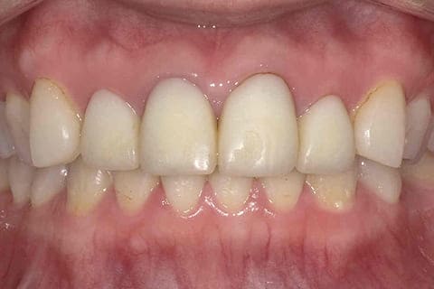 セラミック審美歯科の治療前
