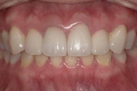 審美歯科セラミック 術後