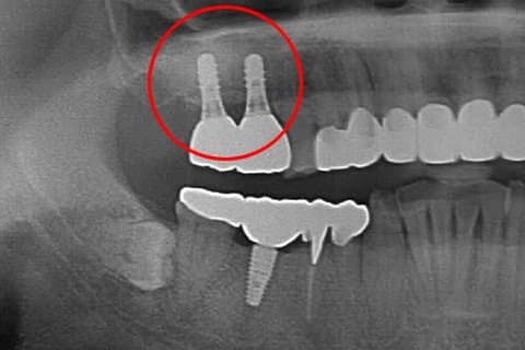 サイナスリフト 術後