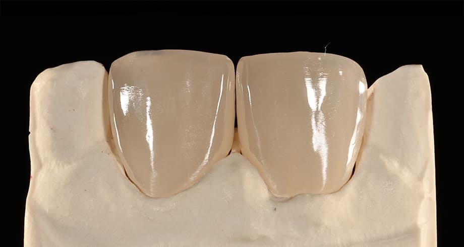 歯を削らない審美歯科治療