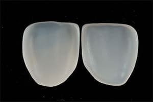 歯を削らないラミネートべニア