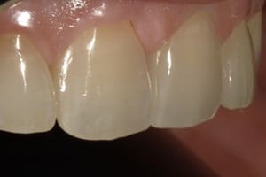 歯を削らないラミネートべニアの特徴