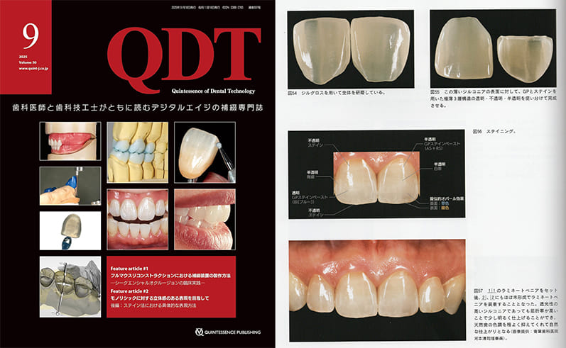 歯を削らないラミネートべニア治療症例