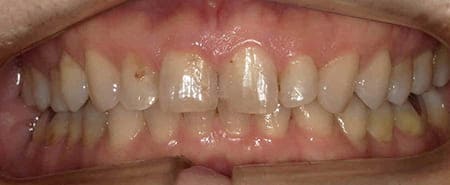 歯を削らないラミネートべニア 術前 口腔内