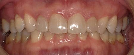 歯を削らないラミネートべニア 術後 口腔内