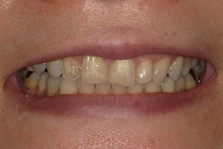 歯を削らないラミネートべニア 術前 口元