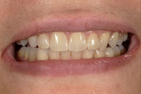 歯を削らないラミネートべニア 術後 口元